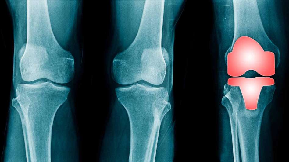 Knee injury shown on an X-ray